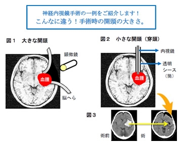 内視鏡下脳内血腫除去術 内視鏡下脳内血腫除去術