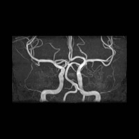 頭部MRA画像